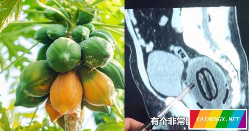 男子腹痛6小时羞于求医 直肠惊现20公分大木瓜 