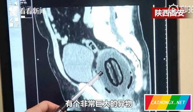男子腹痛6小时羞于求医 直肠惊现20公分大木瓜 