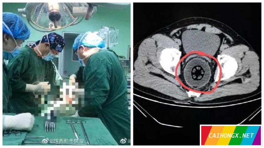 男子腹痛6小时羞于求医 直肠惊现20公分大木瓜 