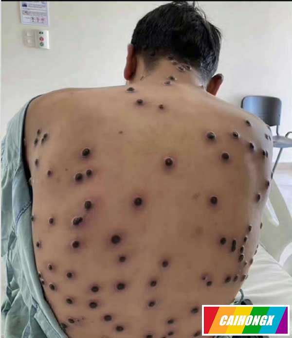 中疾控：11月新增报告80例猴痘确诊病例 猴痘,性行为