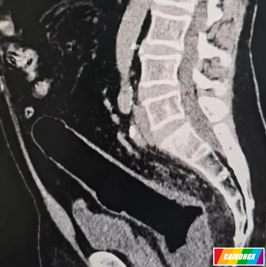 深圳中年男称“不慎坐到”假阳具滑入肛门，硬拖3天致肠道穿孔 